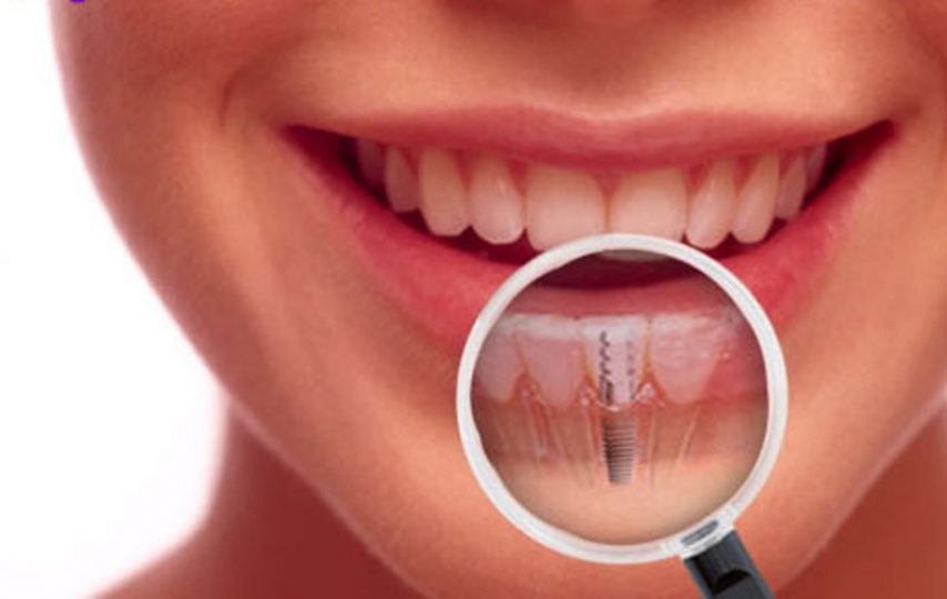 dentalimplants